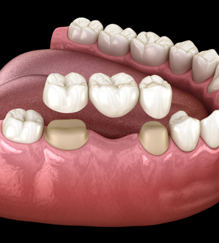 Q-Family-Dental-Bridge