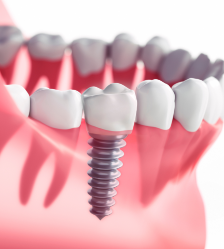 Q-Family-Dental-Dental-Implants
