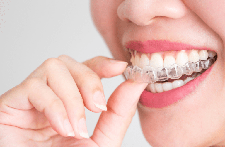 Invisalign at Q Family Dental Tigard OR